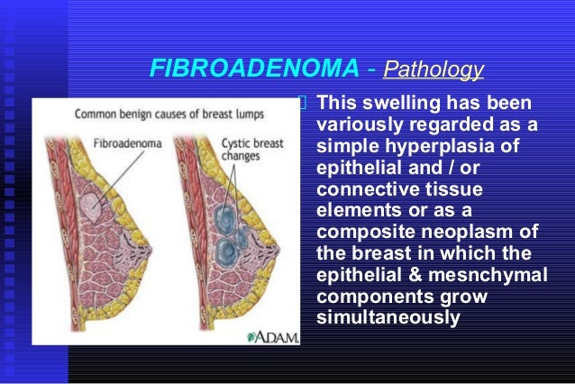 benign breast in lump Benign breast in lump